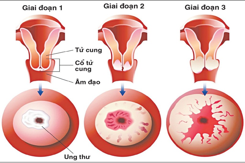 Các giai đoạn của ung thư cổ tử cung.